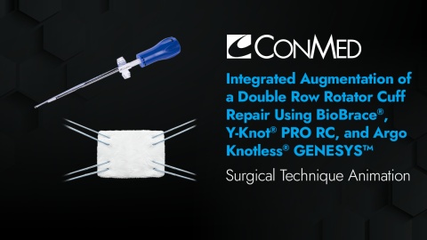 Integrated Augmentation of Double Row Rotator Cuff Repair Using BioBrace®, Y-Knot® PRO RC, and Argo Knotless® GENESYS™