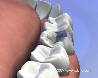 FAQ about Apicoectomy treatment - Beverly Hills Advanced Specialties of  Dentistry