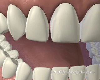 Dental Bonding in Las Vegas  Tooth Bonding in Spring Valley