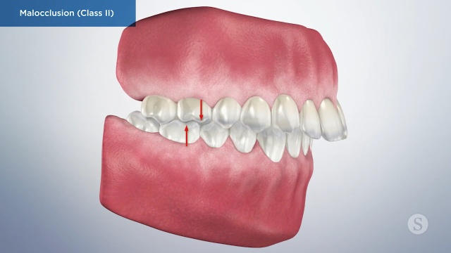Malocclusion (Class II) - Cosmetic Dentistry