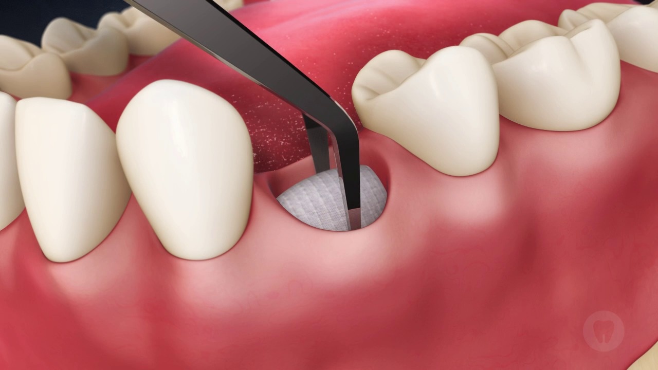 Tooth Loss: Minimize Bone Loss with Graft