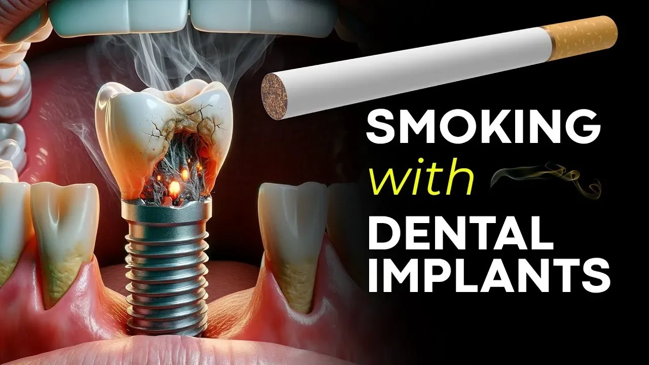 The Effects of Smoking on All-on-4 Dental Implants, image size:1280x720