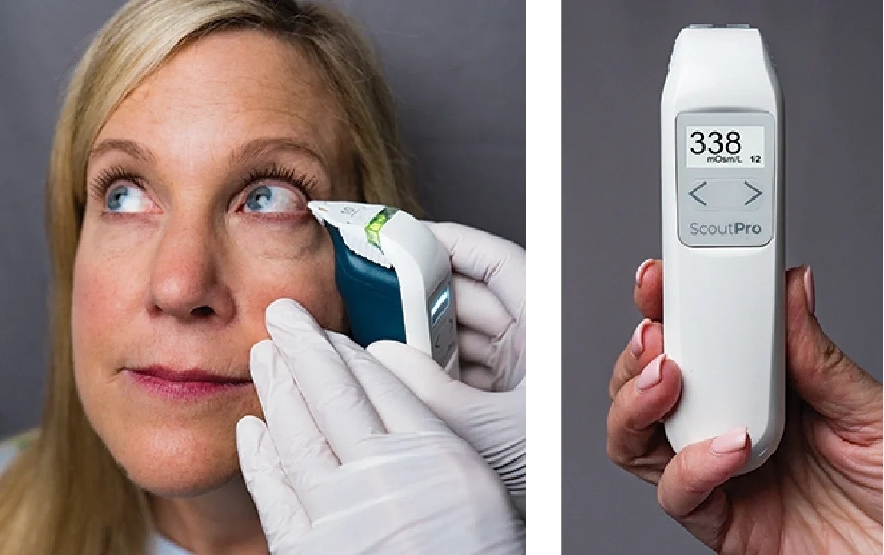 Clinician collecting a tear sample from the lower lid margin with the ScoutPro pen