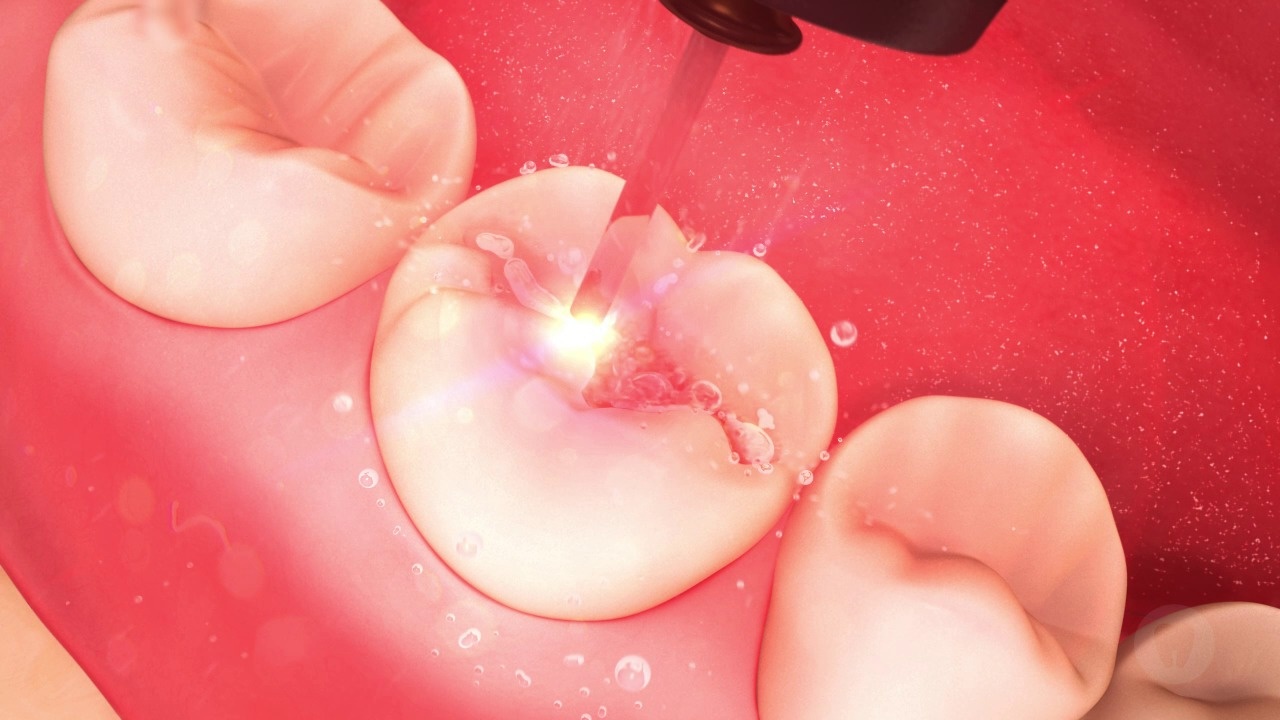 Hard Tissue Laser: Decay Removal