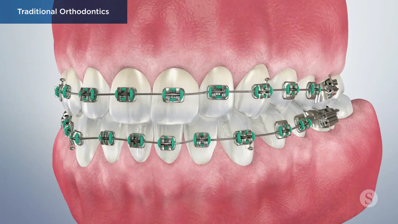The Pros and Cons of Ceramic Braces - Orange Coast Orthodontics -  Orthodontist Laguna Hills, CA
