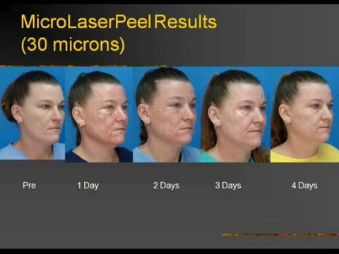 Thumbnail for Optimizing Success and Minimizing Complications with Sciton’s Tunable Resurfacing Laser (TRL)