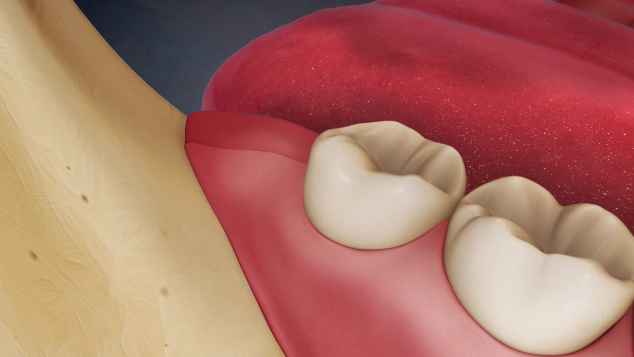 Removal of Impacted Wisdom Tooth
