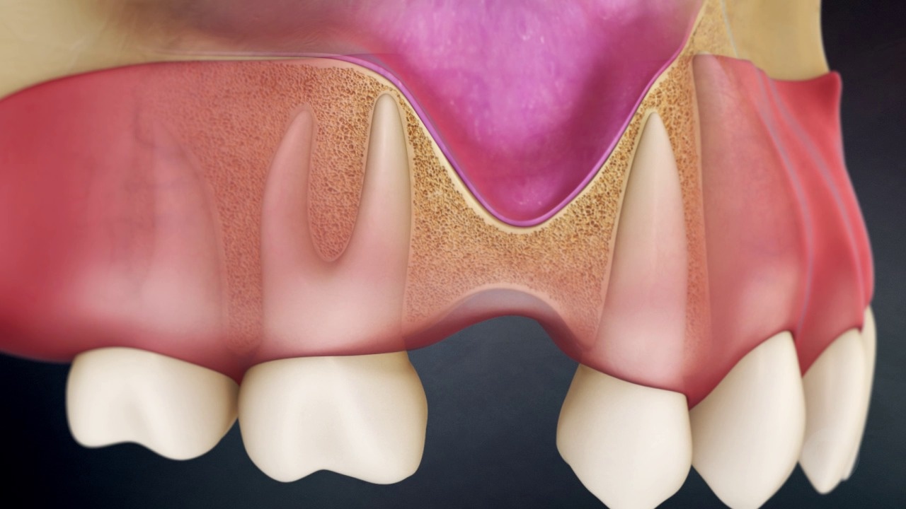 Why You Can't Place A Dental Implant