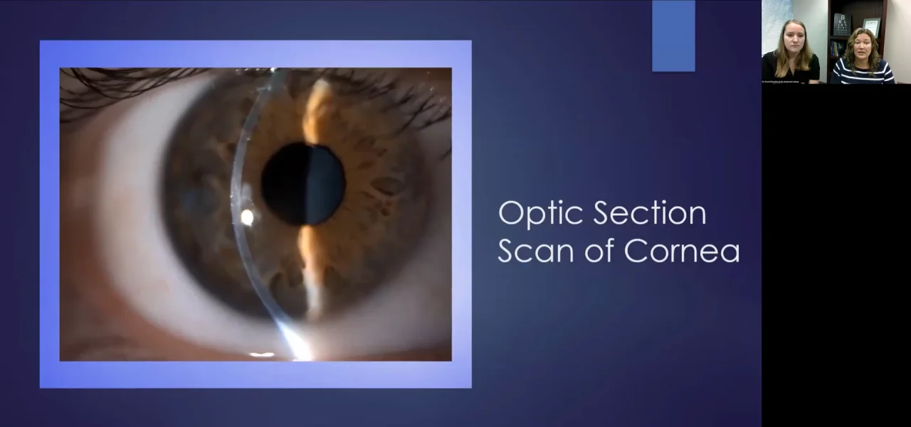 specular reflection cornea