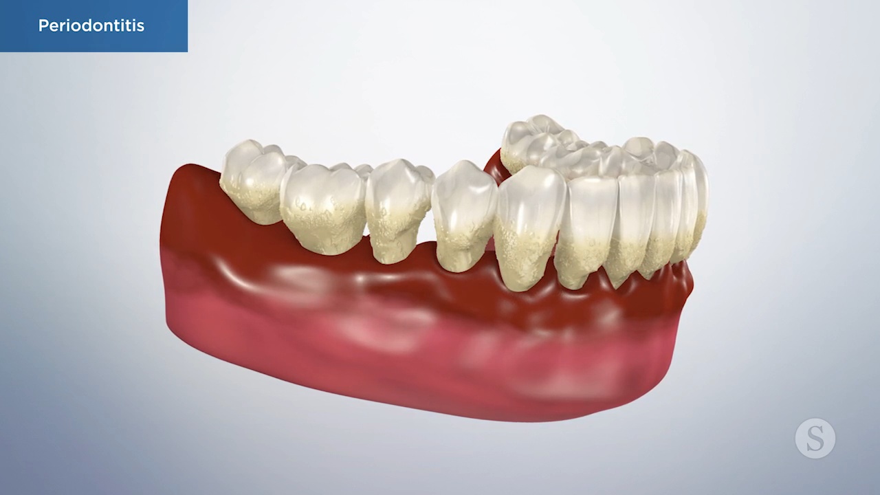 SP009 Periodontitis