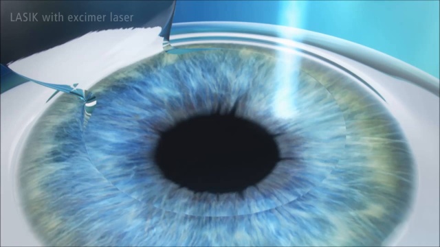 LASIK Eye Surgery Tampa | LASIK St. Petersburg | St. Luke's