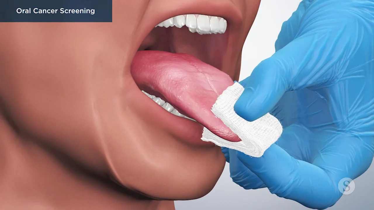 Oral Cancer Screening  Mouth Cancer Screening