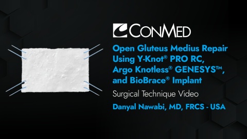 Dr. Nawabi - Open Gluteus Medius Repair Using Y-Knot® PRO RC, Argo Knotless® Genesys™, and BioBrace®