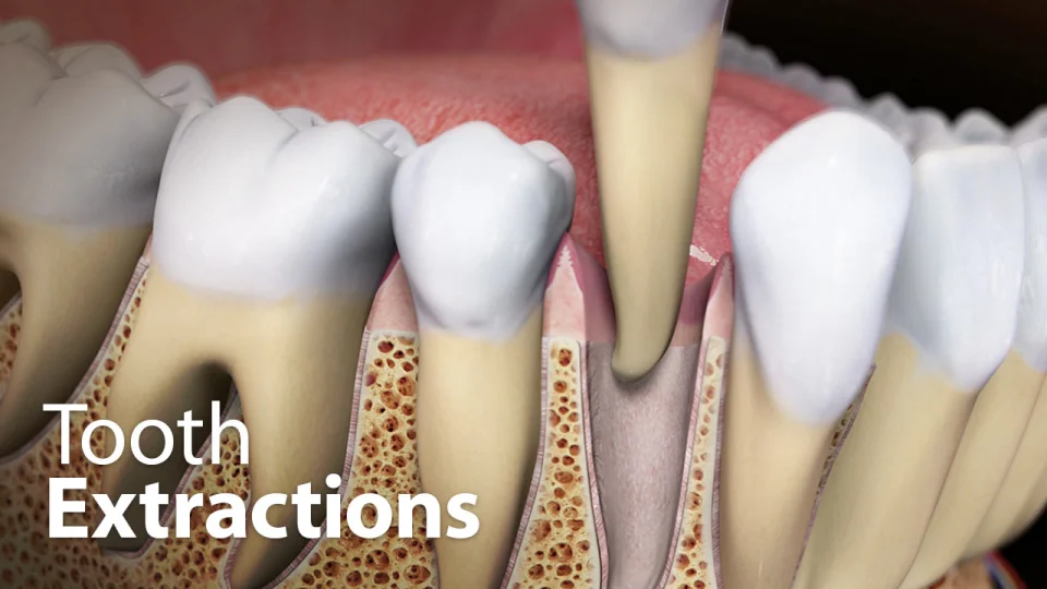 broken baby tooth in adults