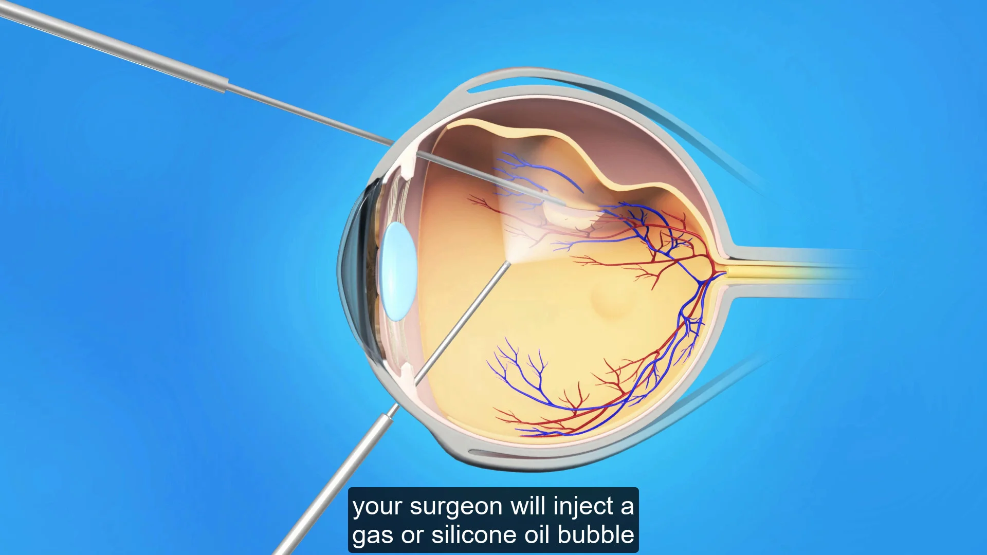 Retinal Detachment - Vitreo-Retinal Consultants