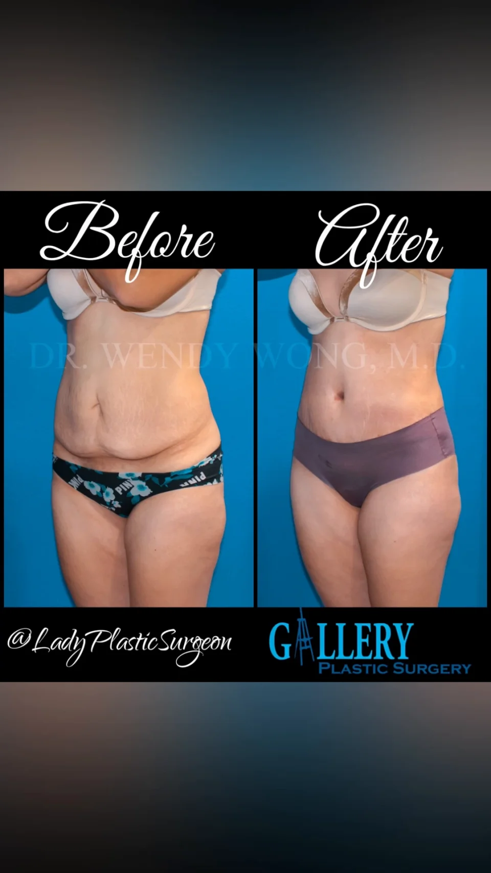 Tummy Tuck Abdominoplasty Surgery in Culver City, CA