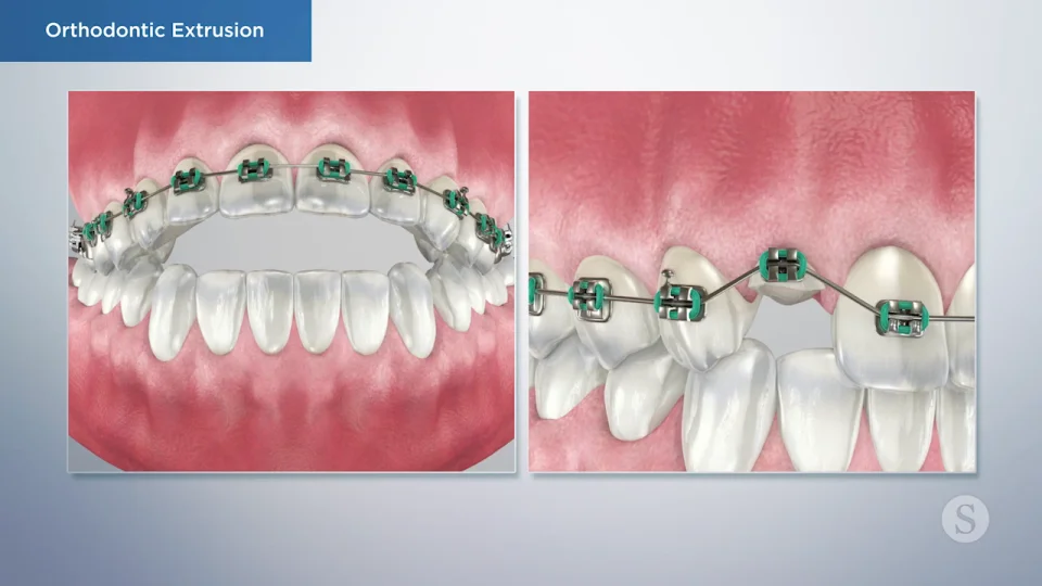Orthodontic Extrusion - Cosmetic Dentistry