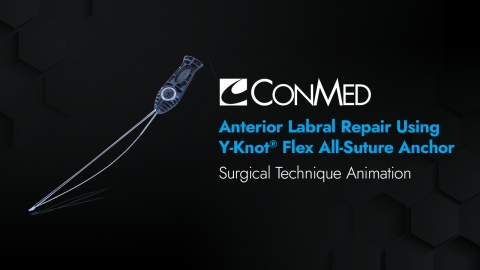Anterior Labral Repair Using Y-Knot® Flex