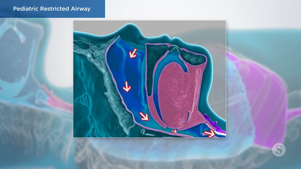 pediatric restricted airway