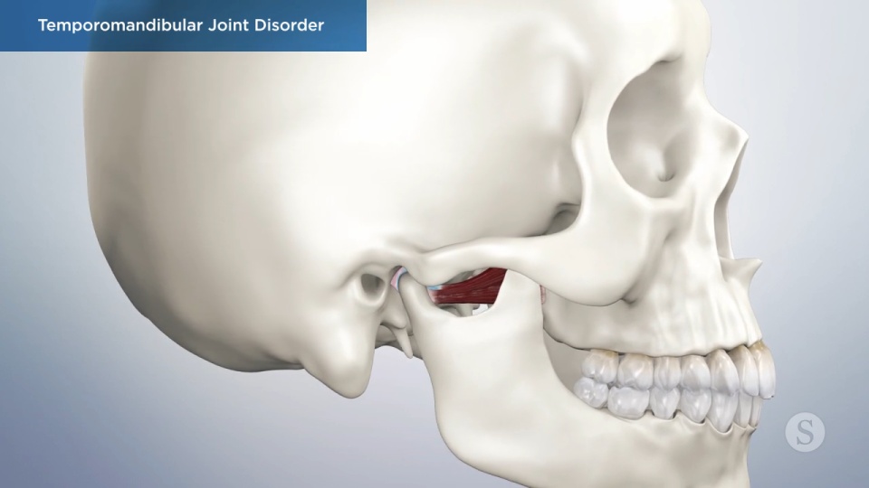 Electrical Muscle Stimulator Provides Pain Relief from TMJ - Dentistry Today