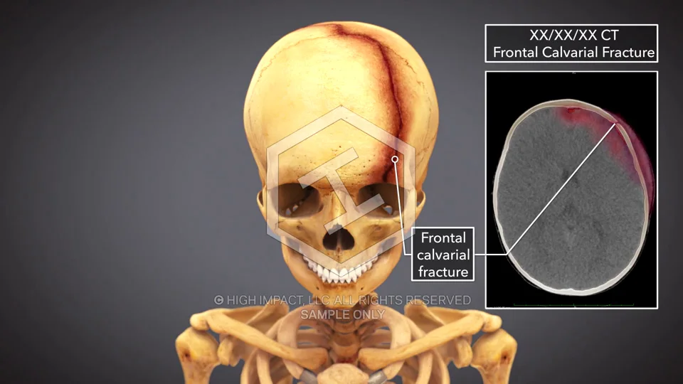 3D Animation Demonstrates Catastrophic Fractures After Tree Limb