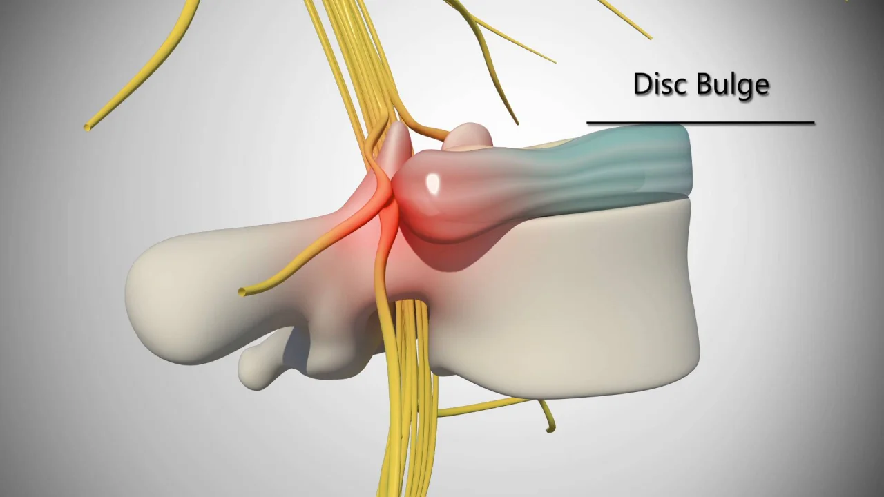 Disc Bulge & Herniated Disc Pain Treatment - Accidentdoctors911