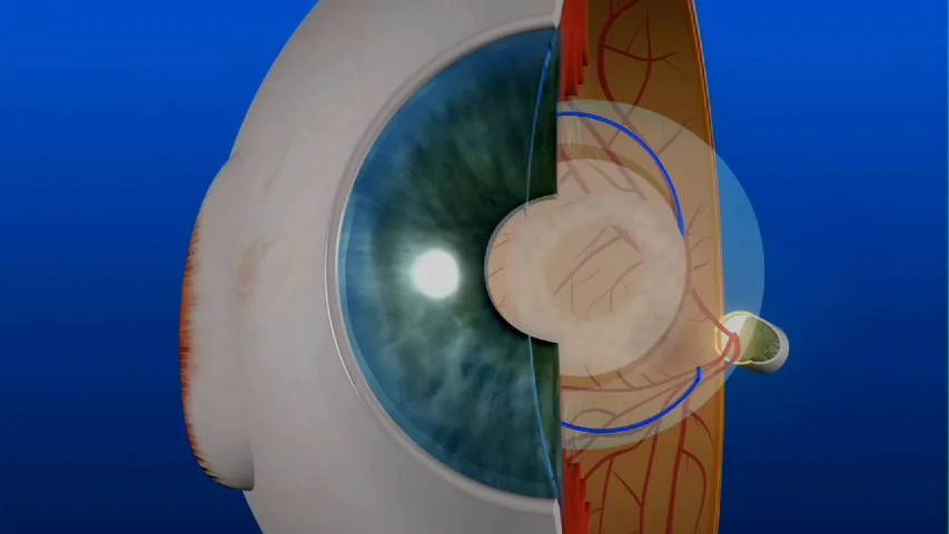 YAG Laser Procedure YAG Laser Procedure