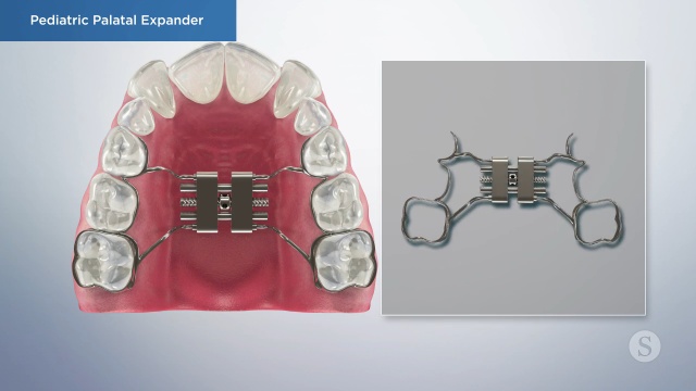What is a Rapid Maxillary Expander?  Orthodontic Care for Pre-Teens Swords  Dublin