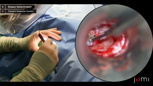 Stapedotomy Animation to Treat Otosclerosis (Curable Type of