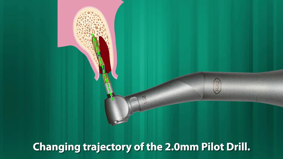 Best Implant Drills, Osteotomy Drill