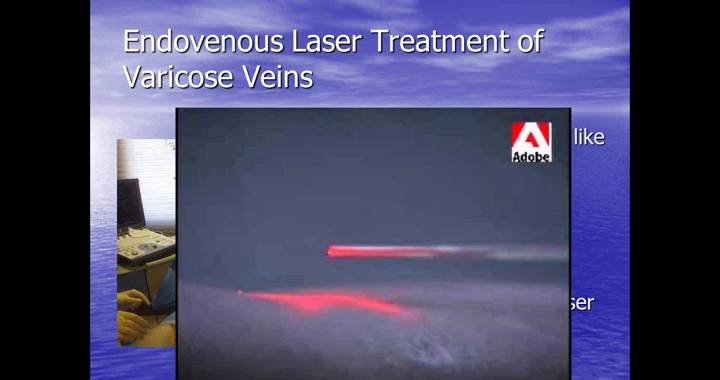 Thumbnail for Marketing and Comprehensive Vein and Vascular Intervention Techniques with the Sciton Laser