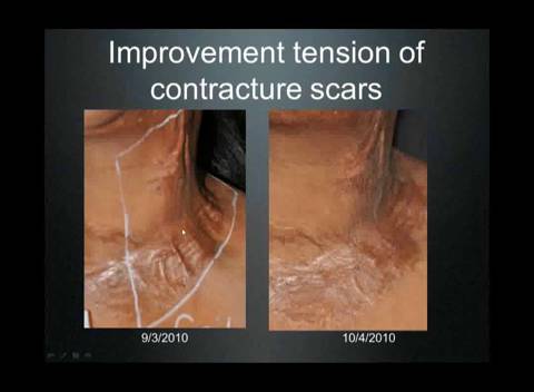 Thumbnail for Laser Scar Reduction with Sciton Laser Technology