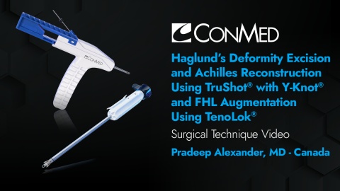 Dr. Alexander - Haglund's Deformity Excision and Achilles Reconstruction Using TruShot® with Y-Knot® and FHL Augmentation Using TenoLok®