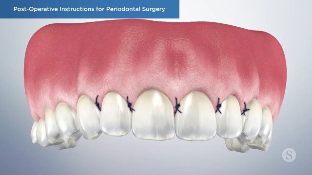 Post-Operative Instructions, Partners in Periodontics