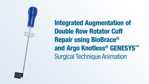 Integrated Augmentation of Double Row Rotator Cuff Repair Using BioBrace® and Argo Knotless® GENESYS™