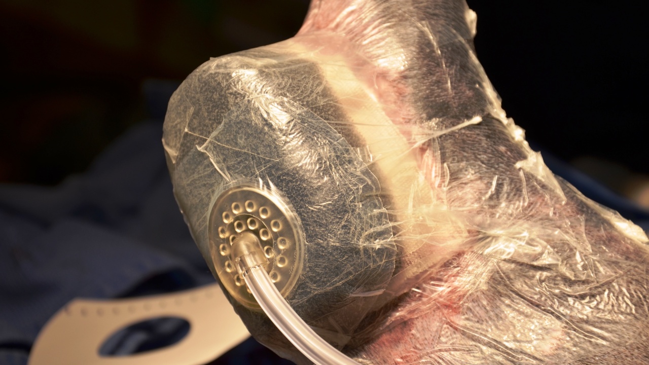 vacuum assisted vac wound therapy