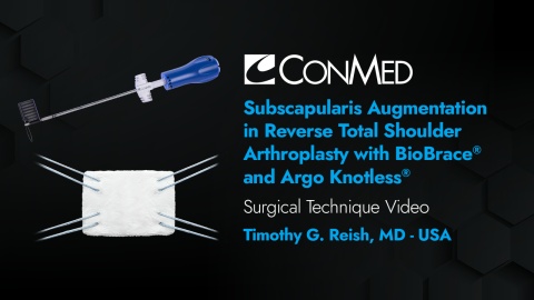 Dr. Reish - Subscapularis Augmentation in Reverse TSA with BioBrace® and Argo Knotless®