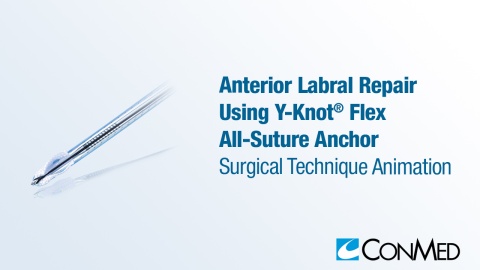 Anterior Labral Repair Using Y-Knot® Flex