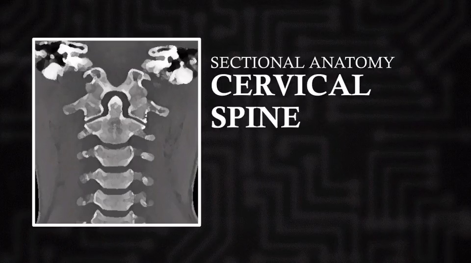 CT Cervical (Coronal) | Video Lesson | Clover Learning