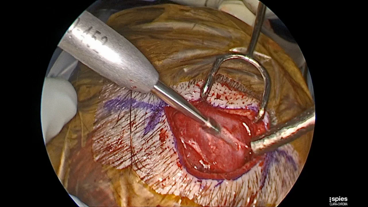  الجراحة بالمنظار (Endoscopic Surgery)
