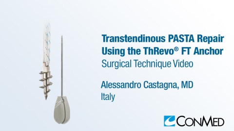 Dr. Castagna - Transtendinous PASTA Repair Using the ThRevo® FT Anchor