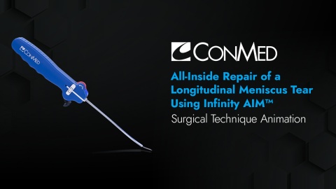 All-Inside Repair of a Longitudinal Meniscus Tear Using Infinity AIM™