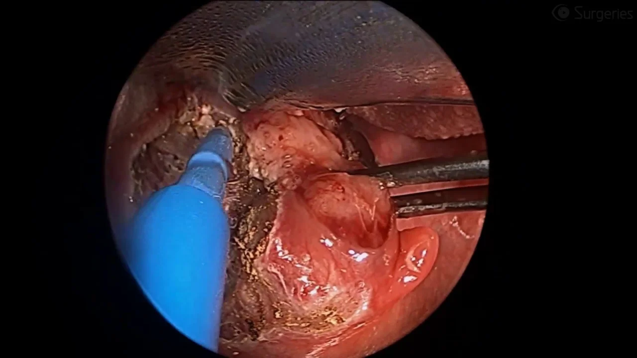 Watch an Electrocautery Procedure 