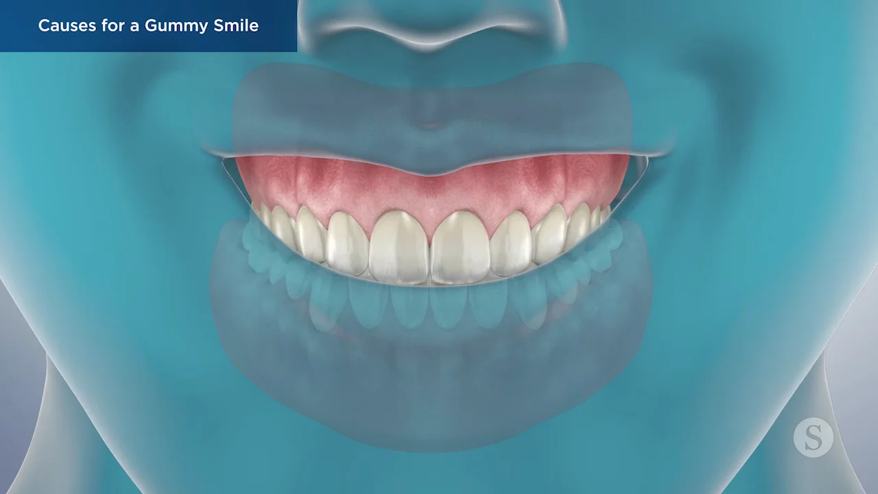 Gummy Smile Treatment - Elite Smiles Dentistry