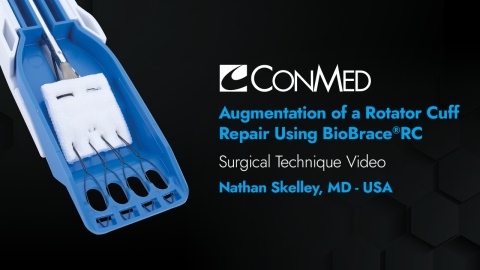 Dr. Nathan Skelley - Augmentation of a Rotator Cuff Repair Using BioBrace®RC
