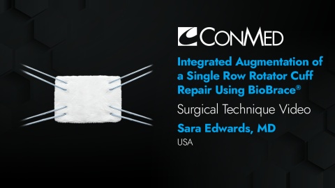 Dr. Edwards - Integrated Augmentation of a Single Row Rotator Cuff Repair using BioBrace®