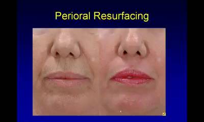 Thumbnail for 2010-09-07 Effectively Erase Perioral and Periorbital Wrinkles