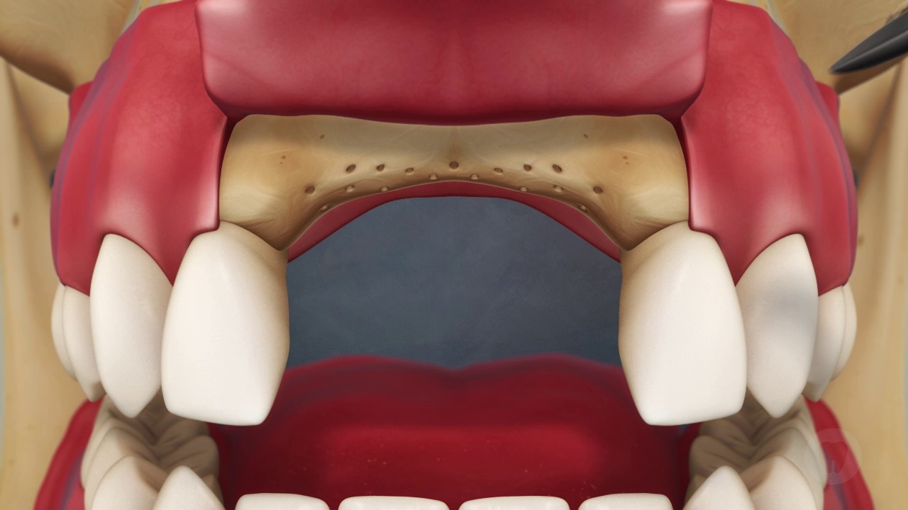 Tooth Loss: Pre-existing Ridge Augmentation