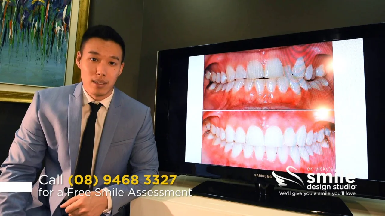 Treating a Narrow arch and Cross bite with Lingual Braces: Case study -  Patient - Allison