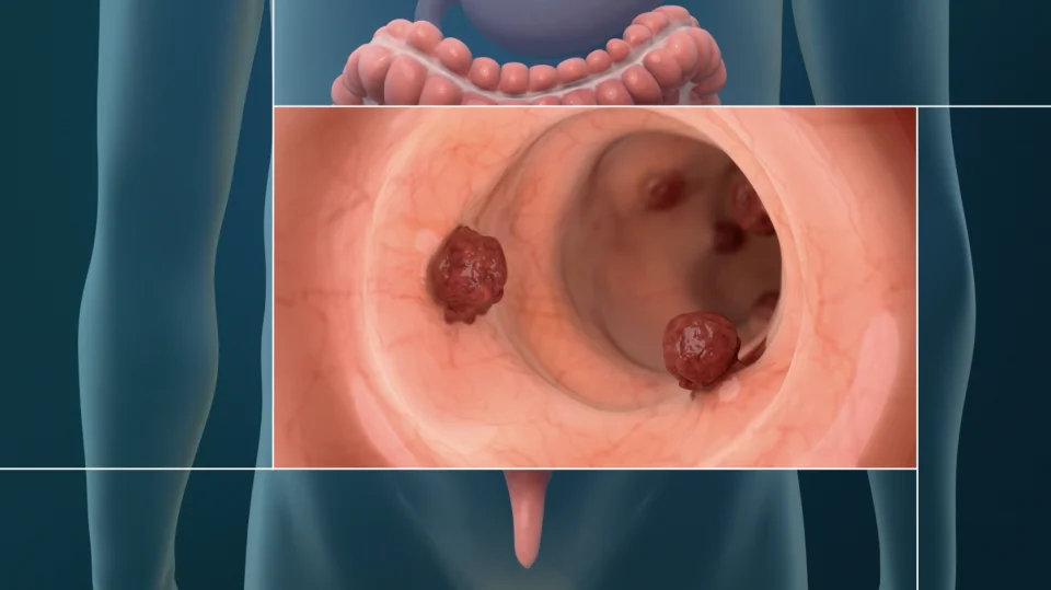 What does colon cancer in stool look like?